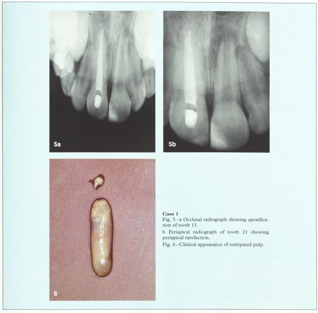 Case 1 Fig. 5.-a Occlusal radiograph showing apexification of tooth 11. b Periapical radiograph of tooth 21 showing periapical rarefaction. Fig. 6.-Clinical appearance of extirpated pulp. sealed.
