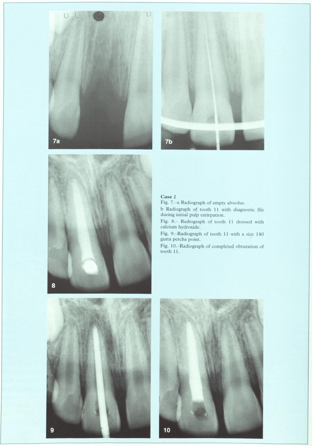 Case 2 Fig. 7.-a Radiograph of empty alveolus. b Radiograph of tooth 11 with diagnostic file during initial pulp extirpation. Fig. 8.