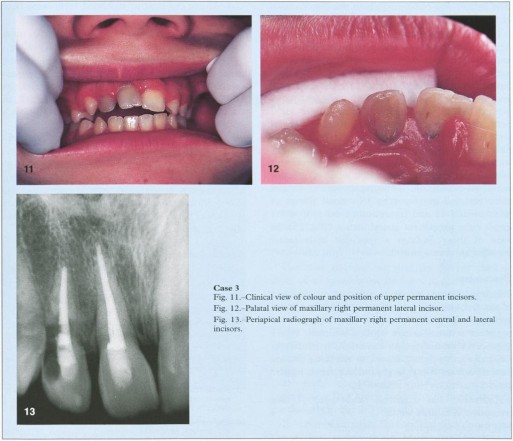 Enclosed information and radiographs revealed a history of complete avulsion of the upper right permanent central incisor three weeks previously (Fig. 7).