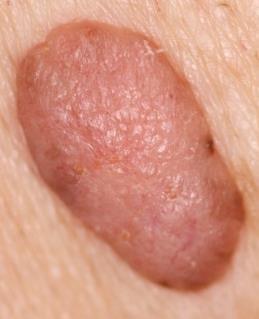 Pinkus BCC Dermatoscopic Findings