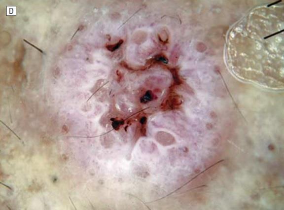 Keratoacanthoma white circles coiled vessels keratin blood