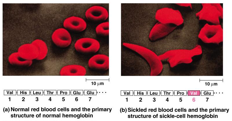 Sickle cell anemia Just 1 wrong out of 146 amino acids!