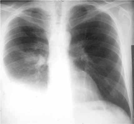 Pleural Tuberculosis PRESENTATION Fever, cough, pleurisy Unilateral sm mod effusion Parenchymal