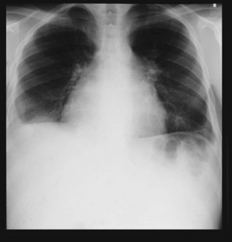 Pericardial Tuberculosis PRESENTATION Cough, wt loss, orthopnea, chest pain, edema, fever Tachycardia, cardiomegaly, JVD, muffled sounds 1/2 with friction rub ECG: ST/TW depression, CXR: