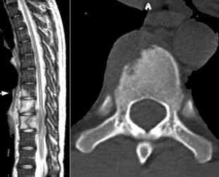 Spinal Tuberculosis Pott s disease PRESENTATION Lower thoracic and lumbar vertebrae Back pain, cold abscess, nerve root compression *scoliosis, limp Bone