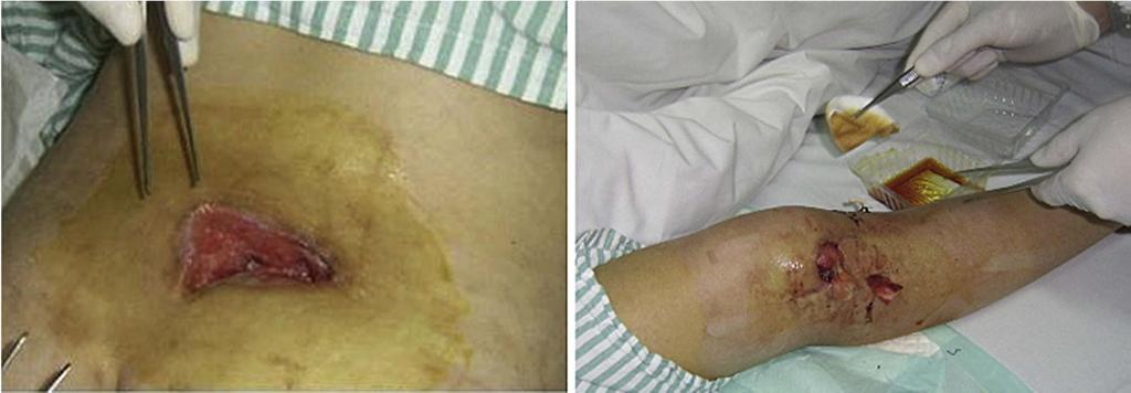 Outbreak of XPTB associated with acupuncture, China 33 XPTB cases
