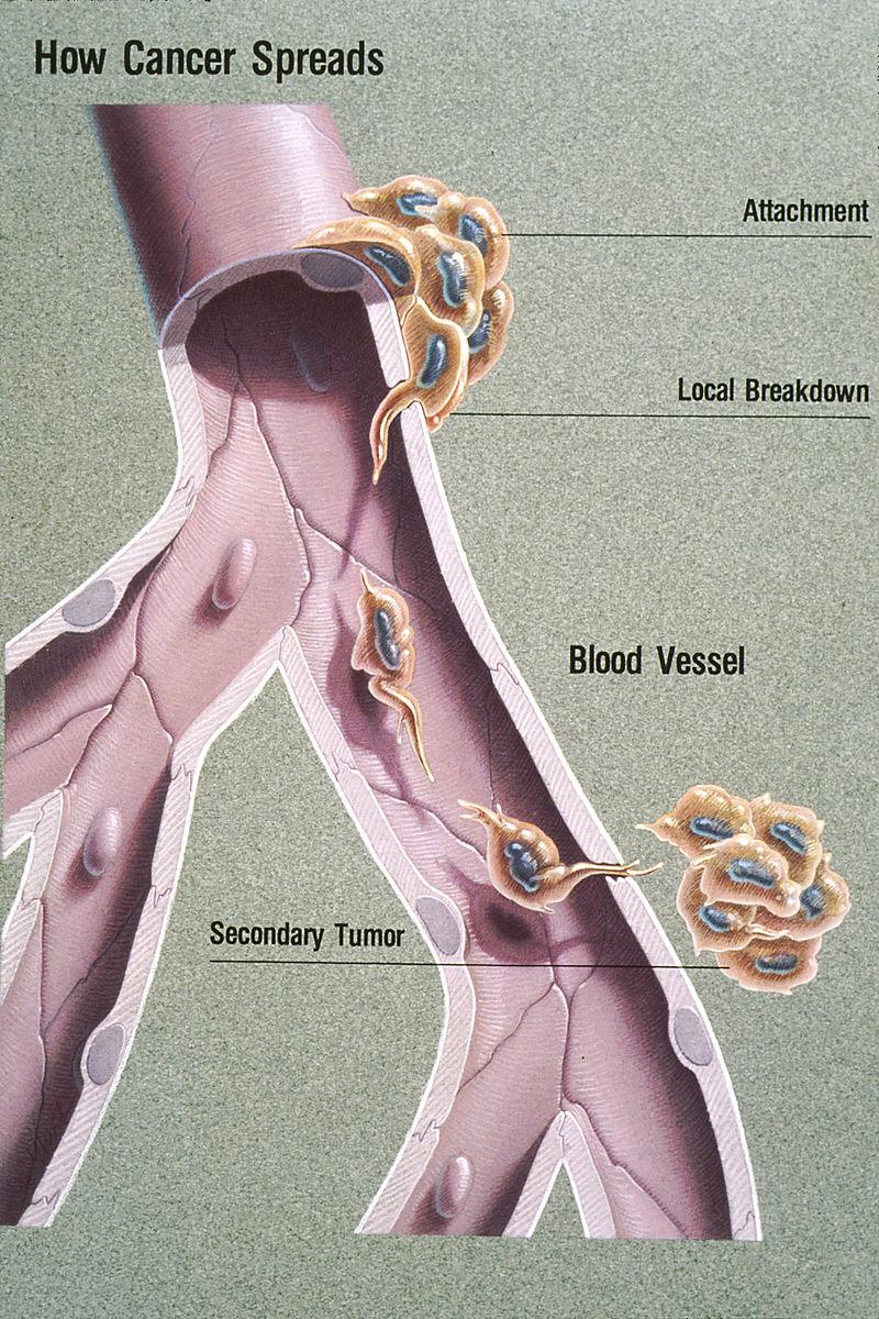 CONCEPT: METASTASIS Metastasis describes the ability of cancer cells to enter the bloodstream and travel to distant parts of the body Very few cells traveling through the bloodstream - First, the
