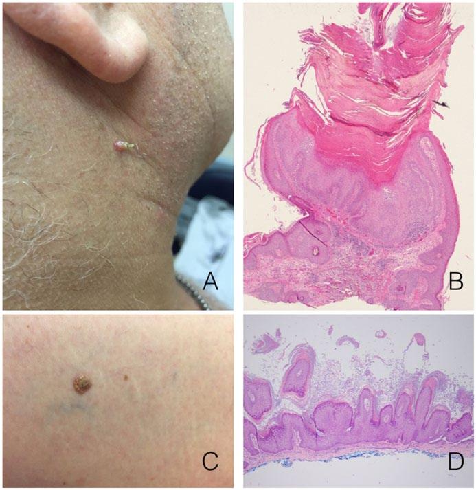 Lacroix and Wang 57 Figure 1. (A) Hyperkeratotic skin-colored papule on neck.