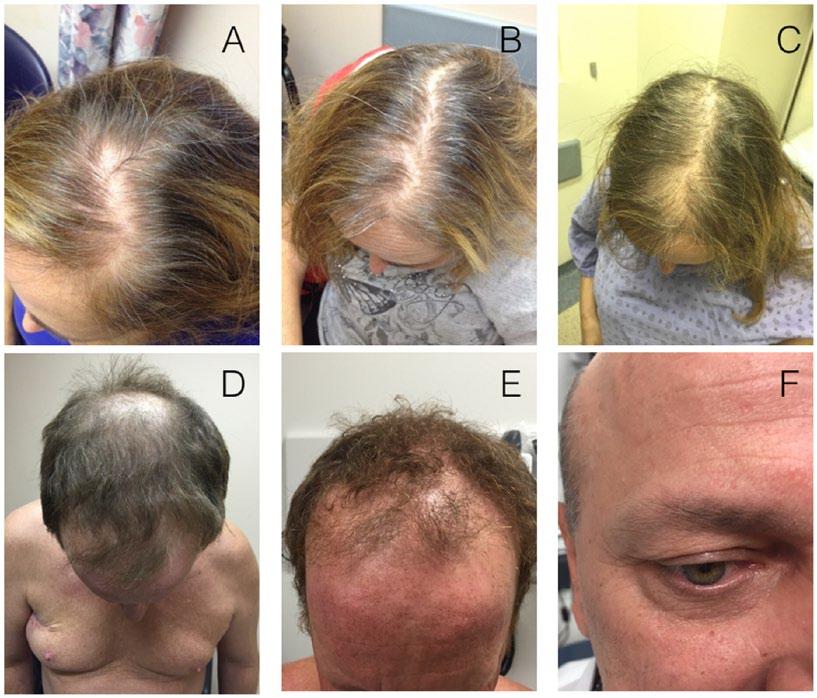 58 Journal of Cutaneous Medicine and Surgery 21(1) Figure 3. (A-C) Progressive diffuse hair thinning at 12, 16, and 20 weeks of treatment with dabrafenib.