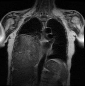 2 Contrast-enhanced CT scan shows a massive tumor occupying most of the left hemithorax, producing mass effect on the mediastinum, diaphragm, and abdominal organs Fig.
