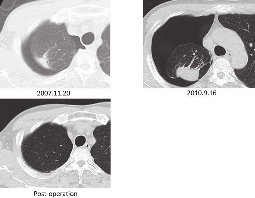 305) Figure 1 The findings of chest computed tomography (CT). Chest CTs before pulmonary resection show pneumothorax with a pulmonary nodule in the right upper lobe.
