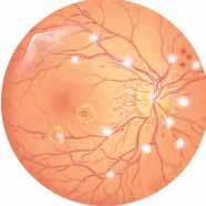 Diabetes and the Eye Diabetes can cause capillaries on the retina to leak or collapse. Then fragile new capillaries may grow on the retina, causing more damage.