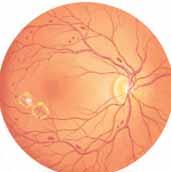 How Your Vision Can Change Diabetic retinopathy may progress from its early stage (nonproliferative) to its later stage (proliferative). Either stage may cause vision loss.