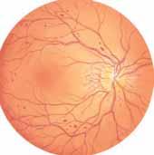 Nonproliferative Diabetic Retinopathy At this stage, capillaries in the retina have been damaged. But there s no growth of fragile new capillaries on the retina.