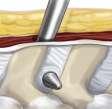Subarticular diameter: 50% Pre-Implant
