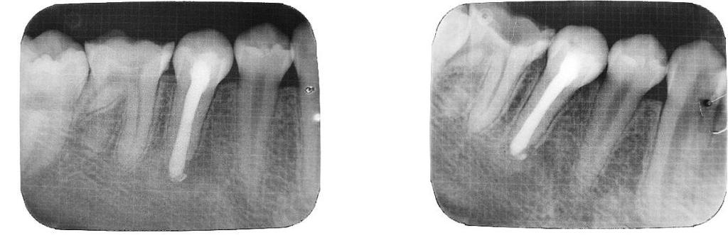 chức cứng sau điều trị đóng cuống các răng