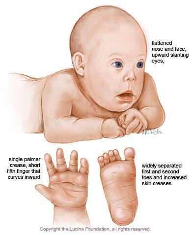 Most widely recognized syndrome Trisomy 21 (one form) Extra chromosome can come from egg or sperm, usually egg Occurs approximately 1 in 700