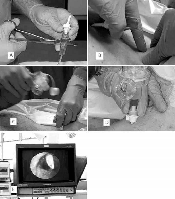 Improvised Cricothyrotomy 83 Figure 1. A, Cutting the drip chamber in half. B, Improvised cricothyrotomy device ready for use. C and D, Attachment of the bag valve mask.