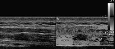 Doppler ultrasound was also able to show differences in the microcirculation in and around active MTrPs compared to latent MTrPs and normal tissue.