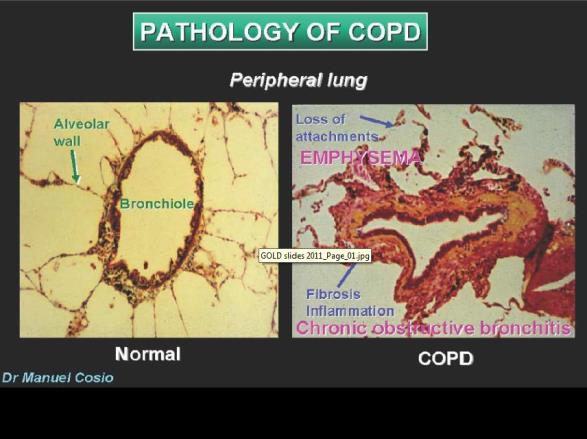 COPD Etiology, Pathobiology & Pathology Factors that influence disease progression Genetic factors