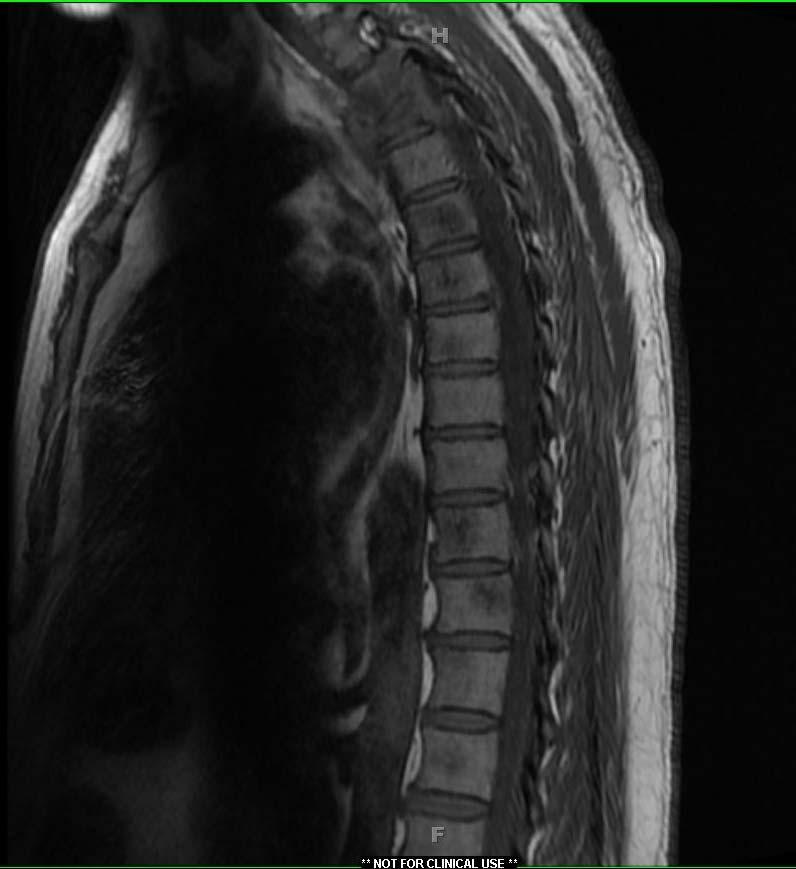 MRI report: - likely metastatic disease - Pathologic 80% vertebral body fracture at T3,