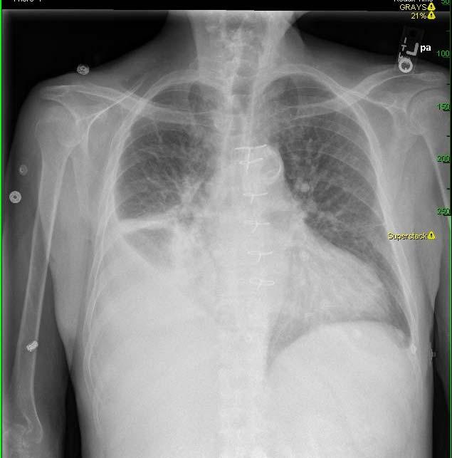 Several months later, he undergoes renal transplant PATIENT 1 New pleural effusion