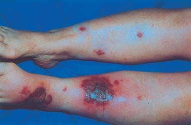 raised borders on the legs Figure 2 Sweet s syndrome: large inflammatory plaques with hemorrhagic bullae on the legs of the underlying hematologic disorder.