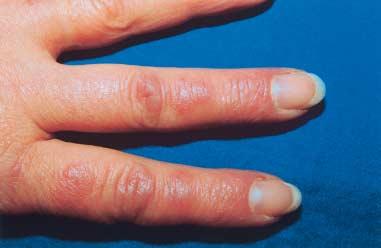 flat papules and plaques on the fingers, particularly over the interphalangeal joints (Gottron s papules) characteristics and skin biopsy, it is recommended to screen for an underlying cancer.