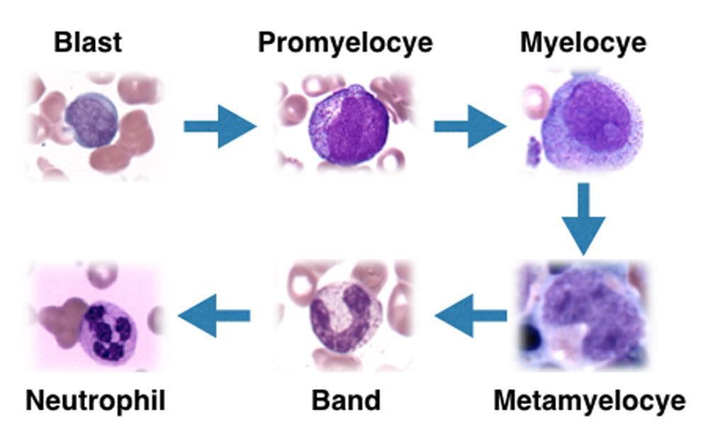 Pathogenesis Mutations that result in arresting myeloid cells at an early stage of differentiation "inability to differentiate " A lot of mutations but please know this example is acute promyelocytic