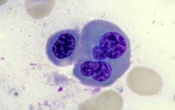 Clinical manifestations Very similar to ALL (huge overlap), don t depend on the age DON T Stigmata of pancytopenia CNS