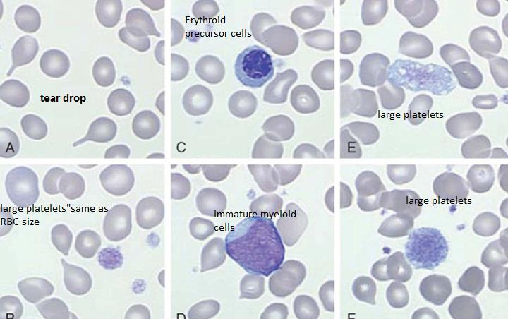 Clinical manifestations Age more than 60 Anemia and splenomegaly Fatigue, weakness and night sweats Lab results Anemia: normochromic and normocytic Leukoerythroblatosis Bone marrow is a must for