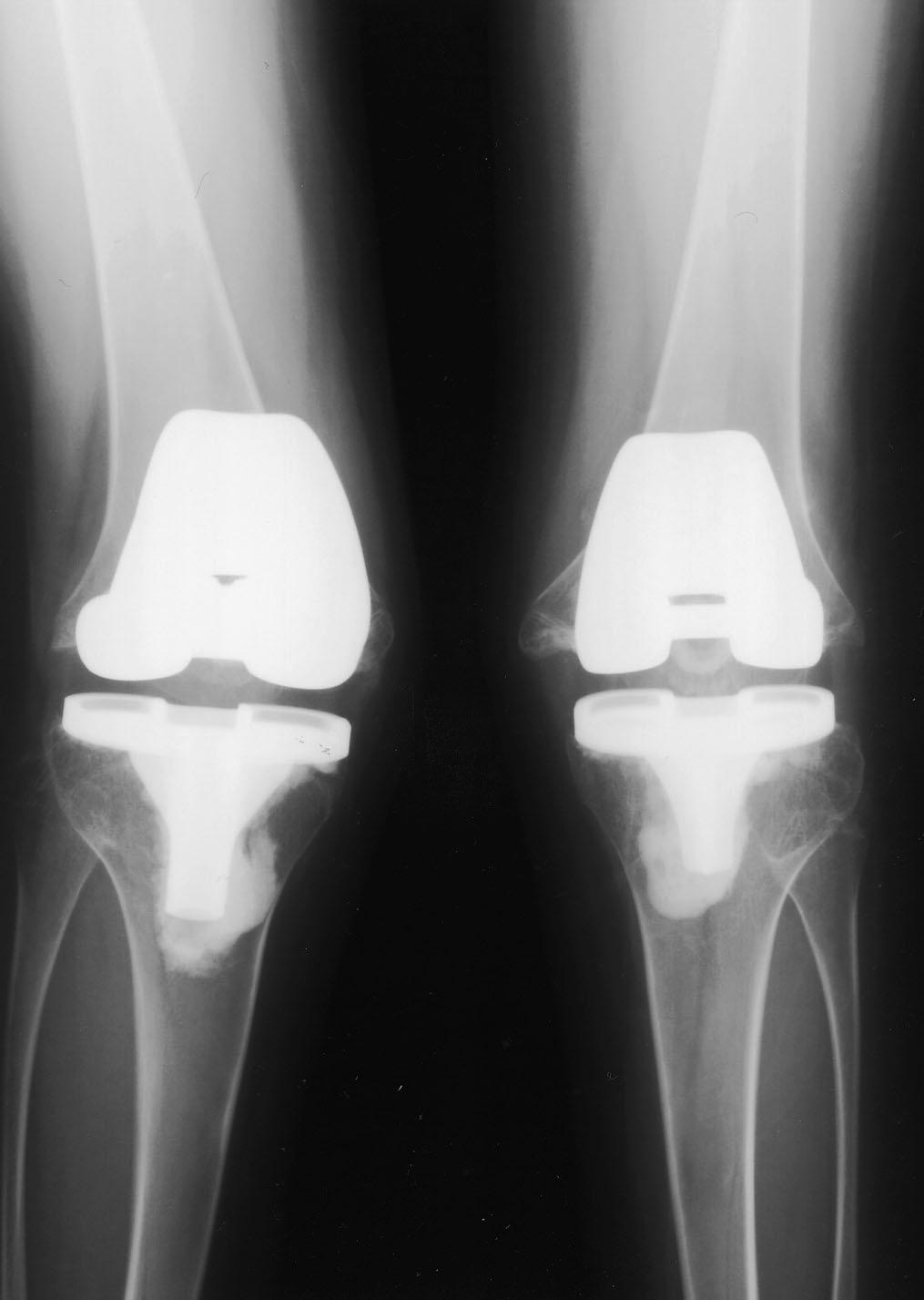 1092 for function, each with a maximum of 100 points. Knee scores were assessed before surgery, at two years, and at the time of the latest follow-up.