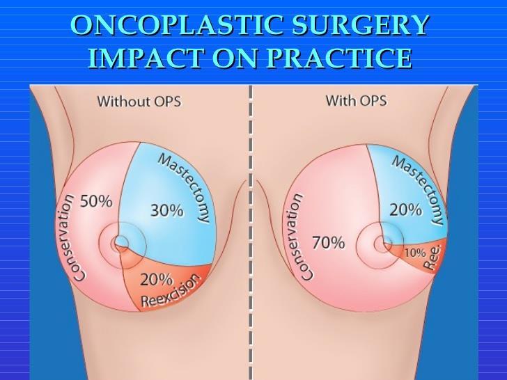 Oncoplastic surgery Further refinement to traditional wide excision Has revolutionized breast surgery Has