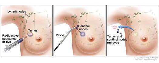 Sentinel lymph node biopsy Avoids the need for axillary