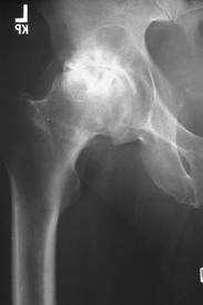 HIP DIFFERENTIAL DIAGNOSES Hip joint pathology OSTEOARTHRITIS Labral tears AVN Reproduced with