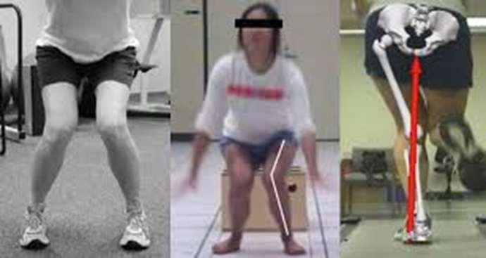 KNEE STRENGTH TESTING Quad VMO weakness Single leg squat