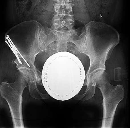 Three Months X-rays revealed that Nadine s osteotomies had healed.