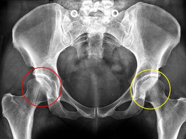 X-ray showing bilateral hip dysplasia as a result of shallow