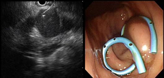 without EUS Visualize vessels and debris Through stomach or duodenum