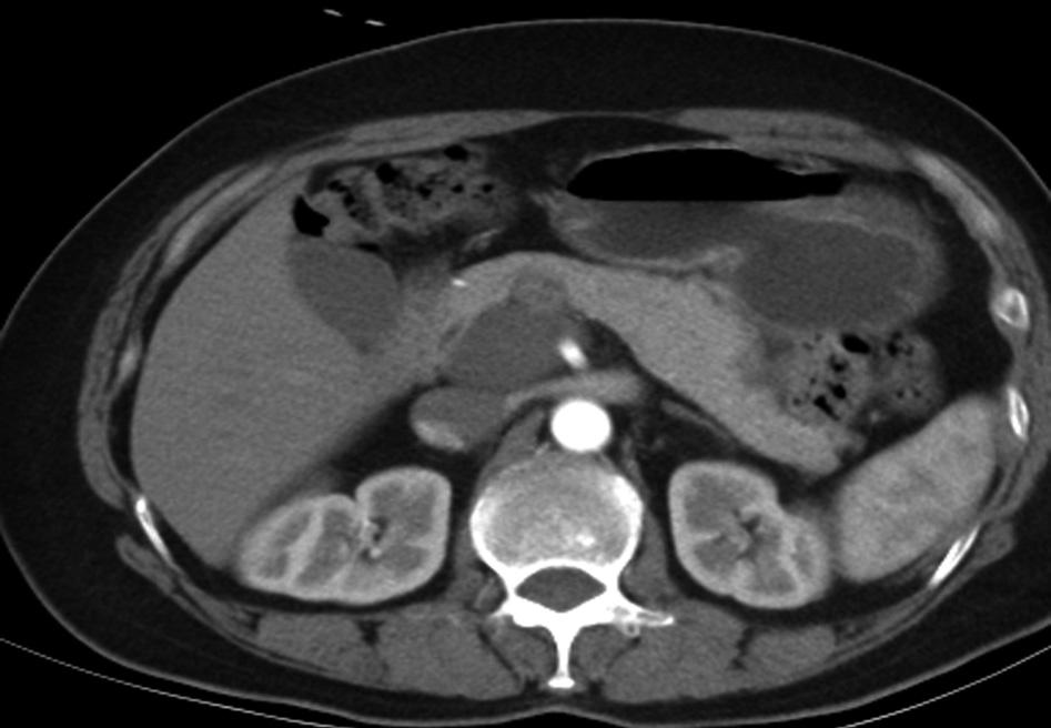 Figure 2 Characteristics of the benign retroperitoneal tumour; computed tomography shows ganglioneuroma in postcaval region, with regular margin, homogeneous density and no enhancement Figure 3