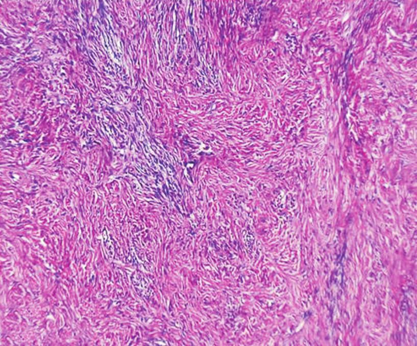 No neuro-epithelial or other mous/mucinous/respiratory epithelial lined cyst wall, seba- immature tissue noted (Fig. 4, 4).