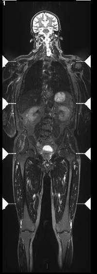 Whole Body MRI : TECHNIQUE 3D T1 Coronal