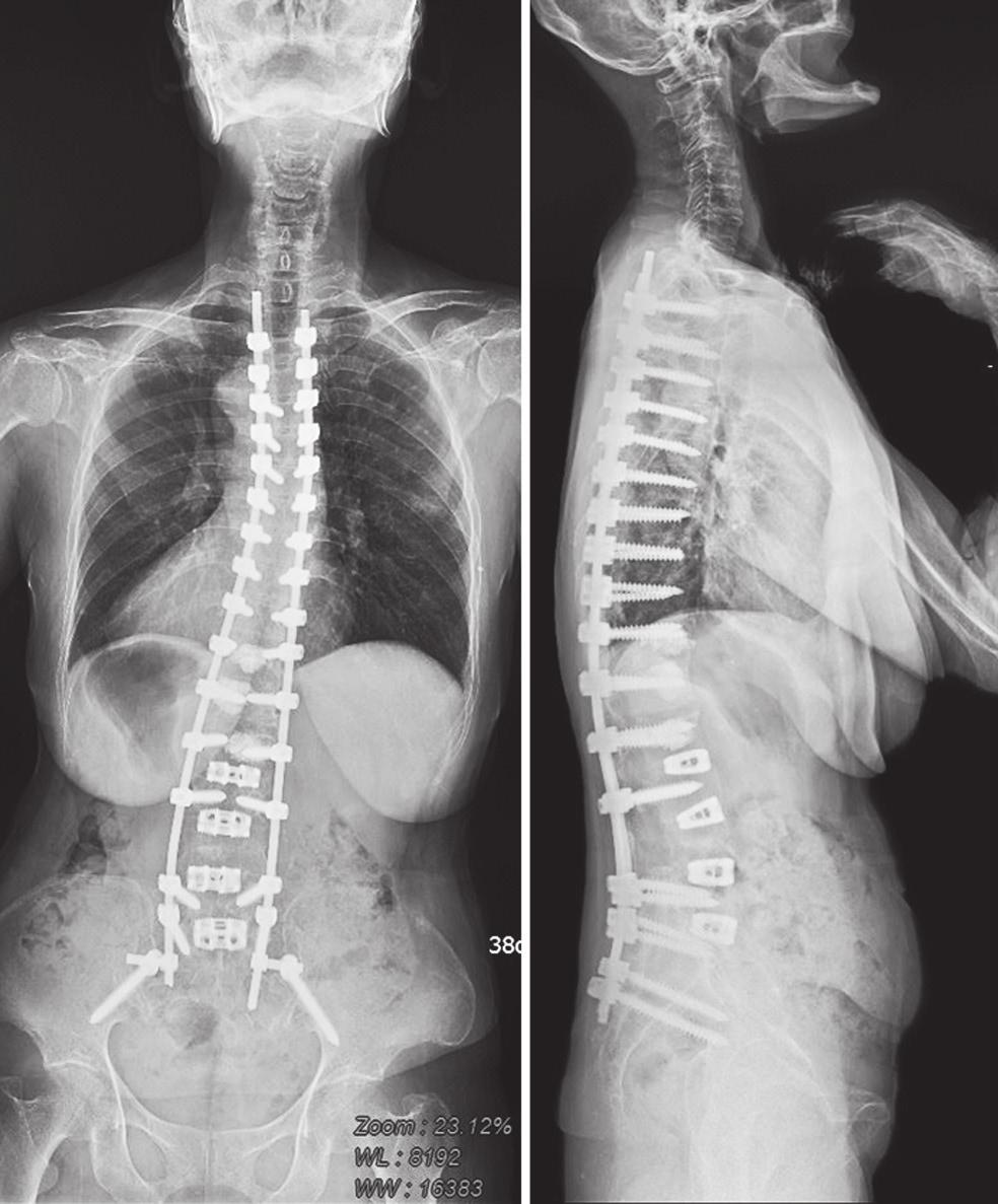 The Subluxation at the proximal level of UIV caused severe thoracolumbar junction kyphosis, trunk shift to left side, disruption of posterior ligament complex, and rod protrusion penetrating the skin.