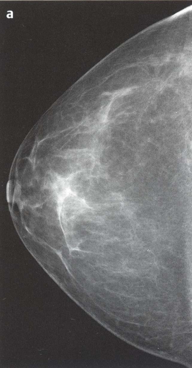 mammography BI RADS Categorization Clinical