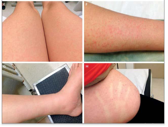 Clinical Presentation 20-40% of infected people recall symptoms Mild febrile illness with viral exanthem Maculopapular rash, conjunctivitis, arthralgias,