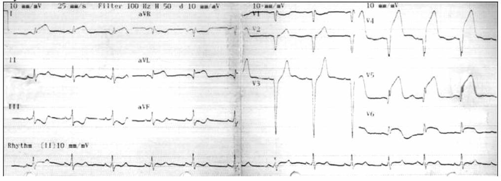 Altekin et al./blunt chest traum 121 infarctions followed by sports injuries (17%).