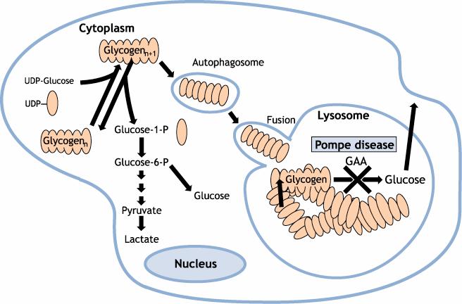 POMPE DISEASE PATHOGENESIS GAA essential for degradation of lysosomal glycogen