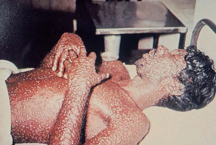 Smallpox 1977 Last reported case Somalia 1980 WHO declared eradication CDC.
