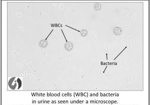 5- Bacteria Bacteria are common in urine specimens because of the abundant normal microbial flora of the vagina or external urethral and because of their ability to rapidly