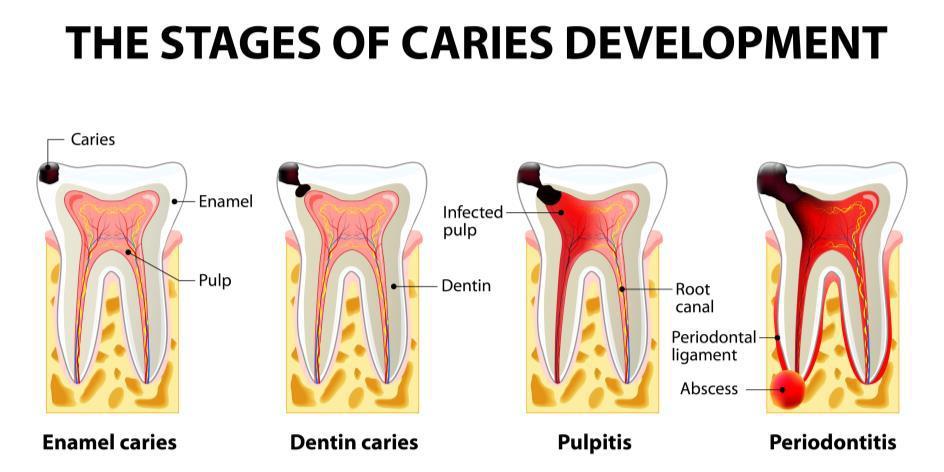 Periodontal disease is classified into two types 1 : Inflammation of the gums 1) Gingivitis, which refers to inflammation limited to the unattached gingiva Common risk factors for gingivitis are: